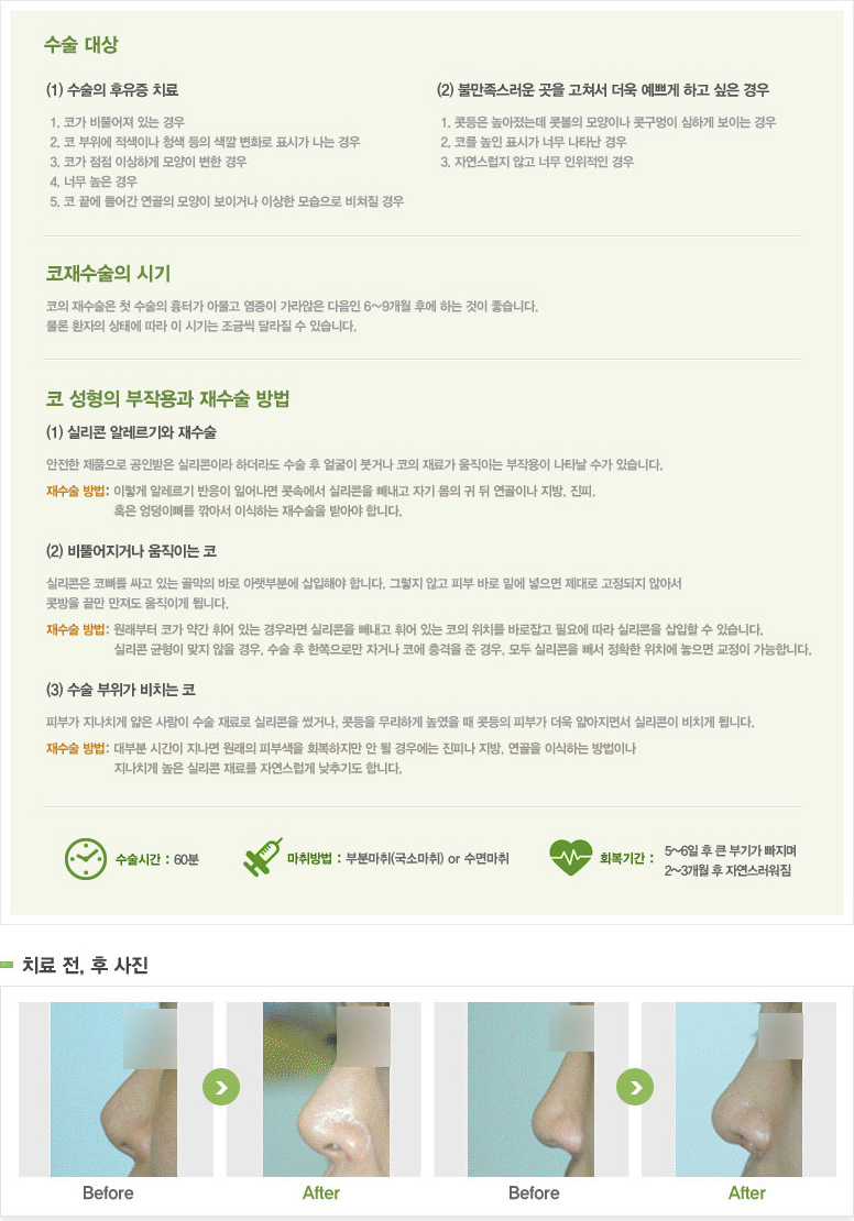 코재수술